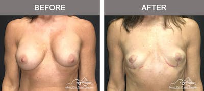 Mastopexy with Capsulectomy Before & After Gallery - Patient 184996 - Image 1