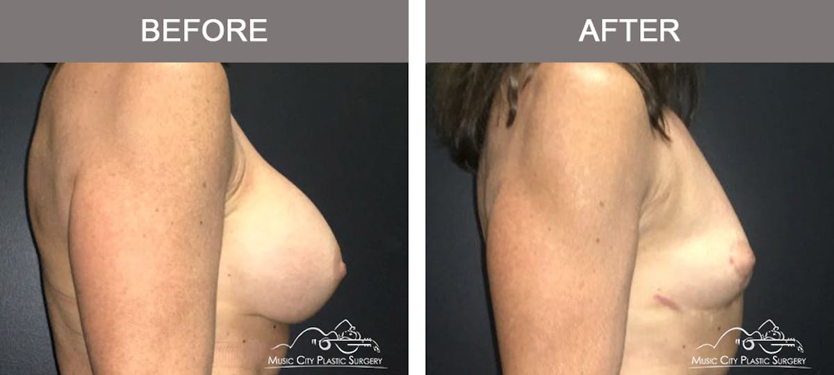 Mastopexy with Capsulectomy Before & After Gallery - Patient 184996 - Image 3
