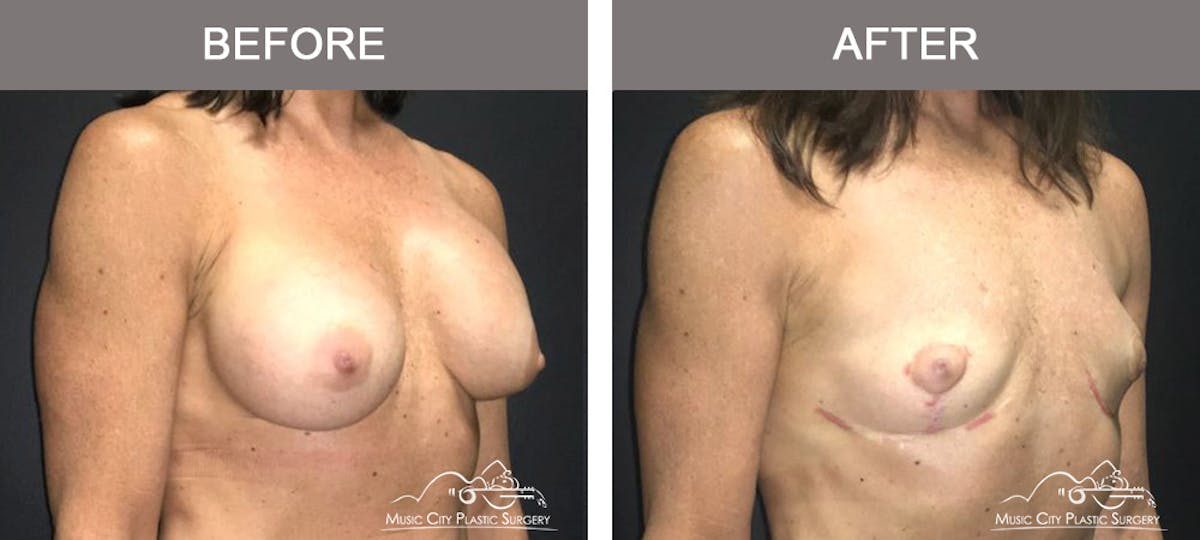 Mastopexy with Capsulectomy Before & After Gallery - Patient 184996 - Image 2