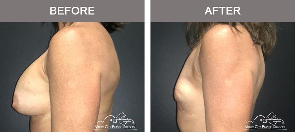 Mastopexy with Capsulectomy Before & After Gallery - Patient 184996 - Image 5