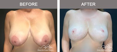 Mastopexy with Capsulectomy Before & After Gallery - Patient 276896 - Image 1
