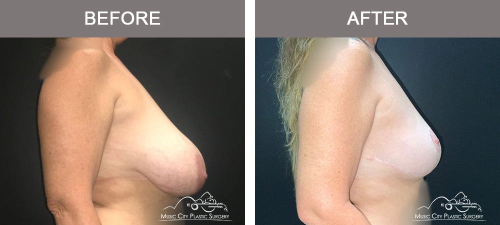 Mastopexy with Capsulectomy Before & After Gallery - Patient 276896 - Image 3