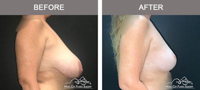 Mastopexy with Capsulectomy Before & After Gallery - Patient 276896 - Image 3