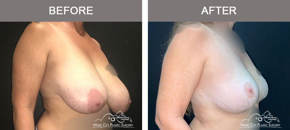 Mastopexy with Capsulectomy Before & After Gallery - Patient 276896 - Image 2