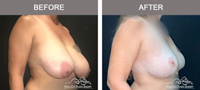 Mastopexy with Capsulectomy Before & After Gallery - Patient 276896 - Image 2