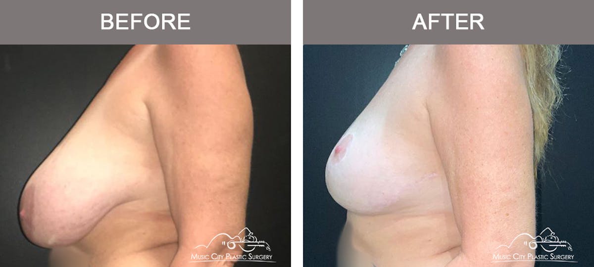 Mastopexy with Capsulectomy Before & After Gallery - Patient 276896 - Image 5
