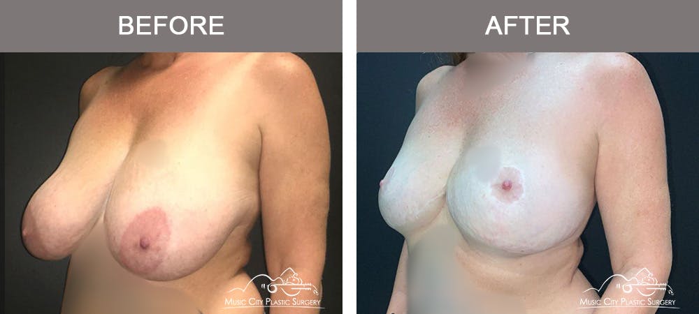 Mastopexy with Capsulectomy Before & After Gallery - Patient 276896 - Image 4