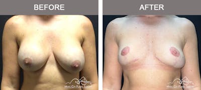 Mastopexy with Capsulectomy Before & After Gallery - Patient 358779 - Image 1