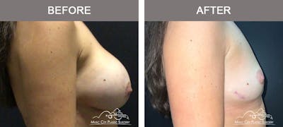 Mastopexy with Capsulectomy Before & After Gallery - Patient 358779 - Image 3