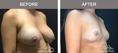 Mastopexy with Capsulectomy Before & After Gallery - Patient 358779 - Image 2