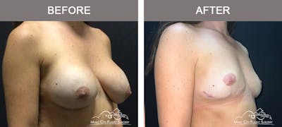 Mastopexy with Capsulectomy Before & After Gallery - Patient 358779 - Image 2