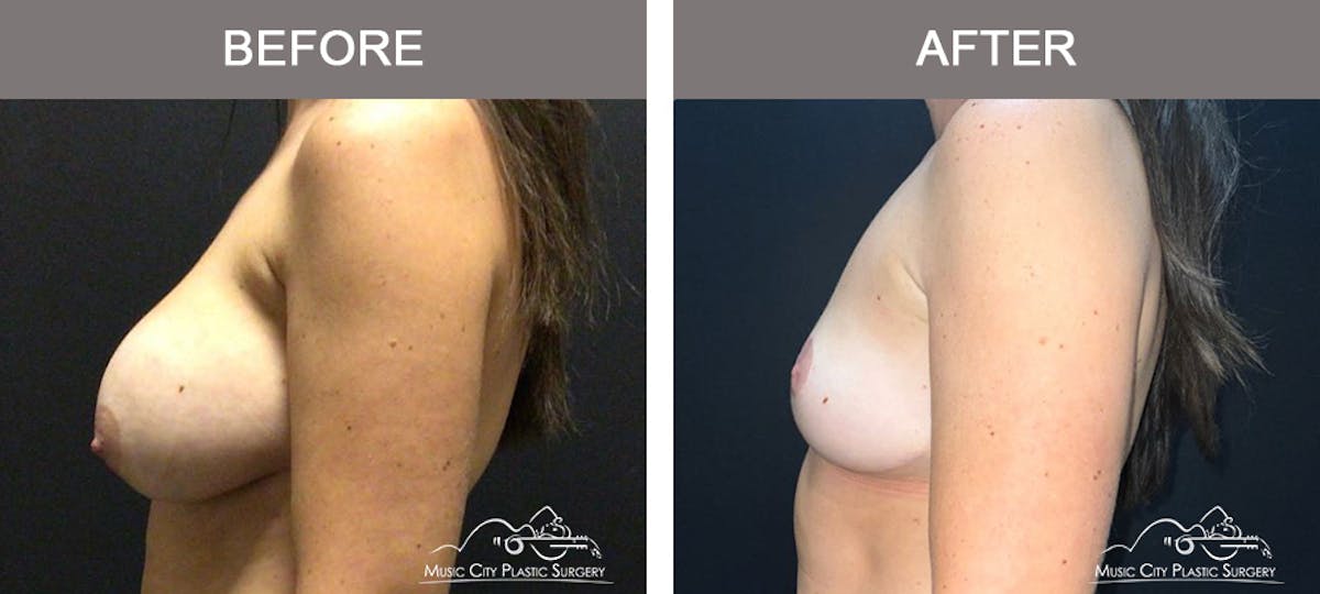 Mastopexy with Capsulectomy Before & After Gallery - Patient 358779 - Image 5