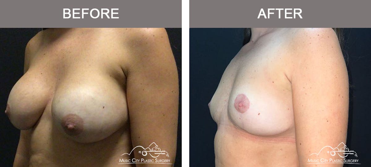 Mastopexy with Capsulectomy Before & After Gallery - Patient 358779 - Image 4