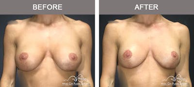 Breast Augmentation Before & After Gallery - Patient 340915 - Image 1