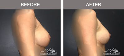 Breast Augmentation Before & After Gallery - Patient 340915 - Image 3