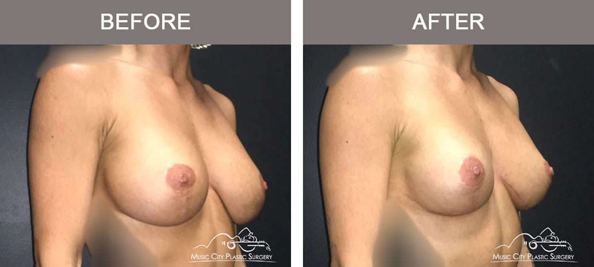 Breast Augmentation Before & After Gallery - Patient 340915 - Image 2