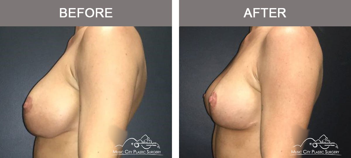 Breast Lift Before & After Gallery - Patient 415145 - Image 5