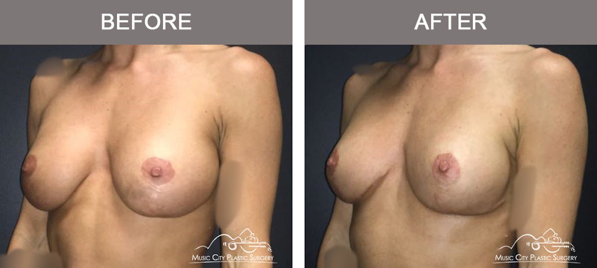 Breast Augmentation Before & After Gallery - Patient 340915 - Image 4
