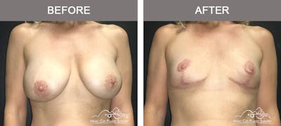 Mastopexy with Capsulectomy Before & After Gallery - Patient 385798 - Image 1