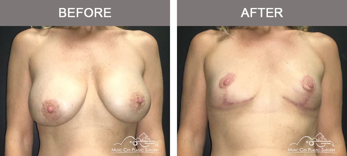 Mastopexy with Capsulectomy Before & After Gallery - Patient 385798 - Image 1