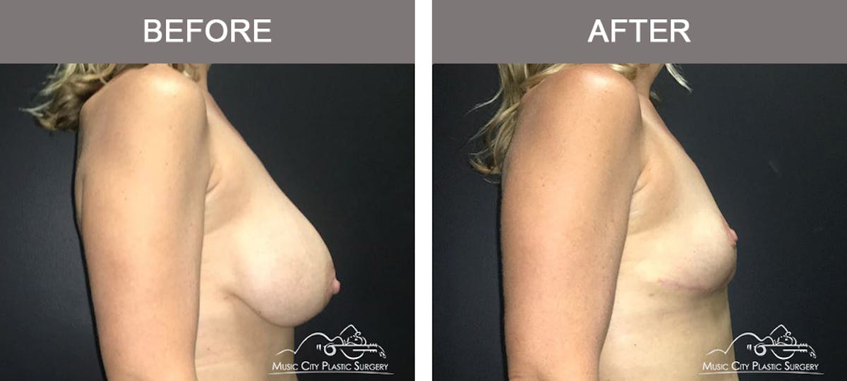 Mastopexy with Capsulectomy Before & After Gallery - Patient 385798 - Image 3