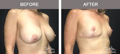 Mastopexy with Capsulectomy Before & After Gallery - Patient 385798 - Image 2