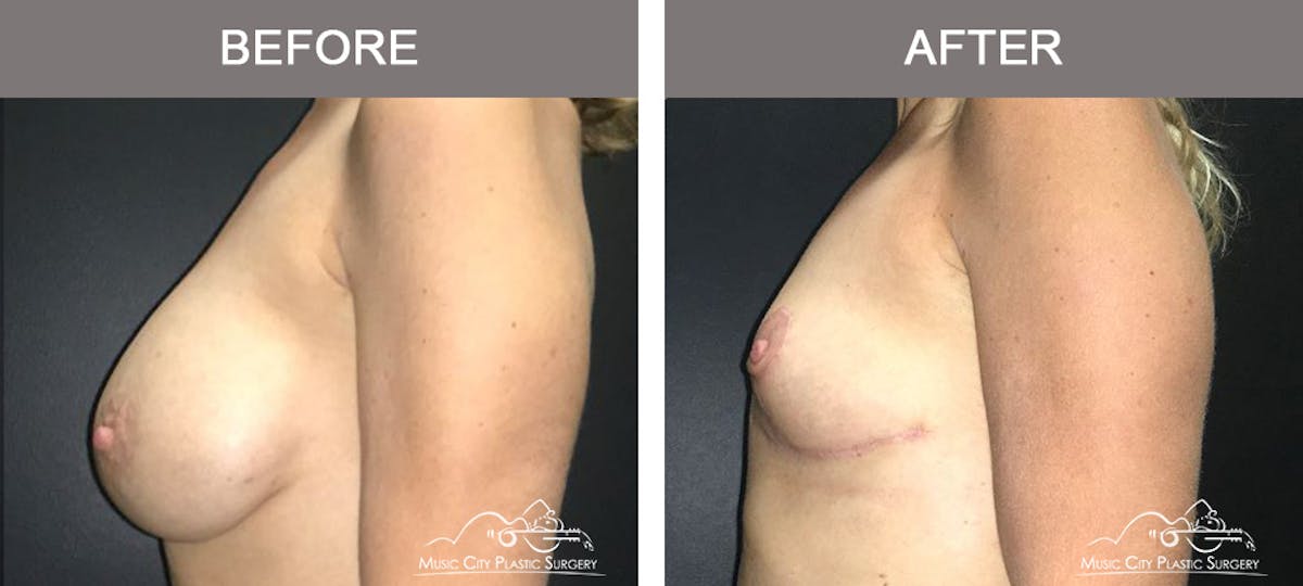 Mastopexy with Capsulectomy Before & After Gallery - Patient 385798 - Image 5