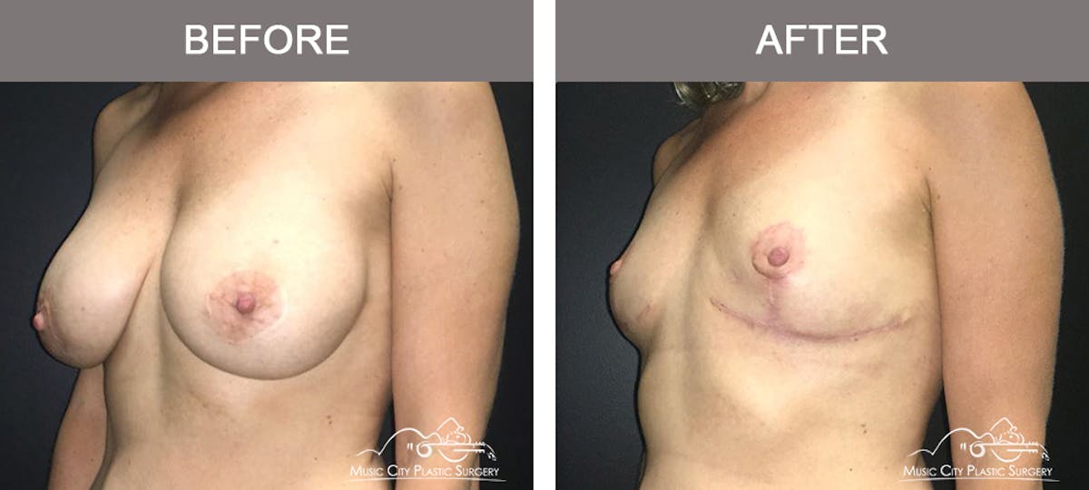 Mastopexy with Capsulectomy Before & After Gallery - Patient 385798 - Image 4