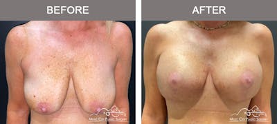 Breast Lift Before & After Gallery - Patient 543148 - Image 1