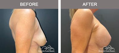 Breast Augmentation Before & After Gallery - Patient 379548 - Image 3
