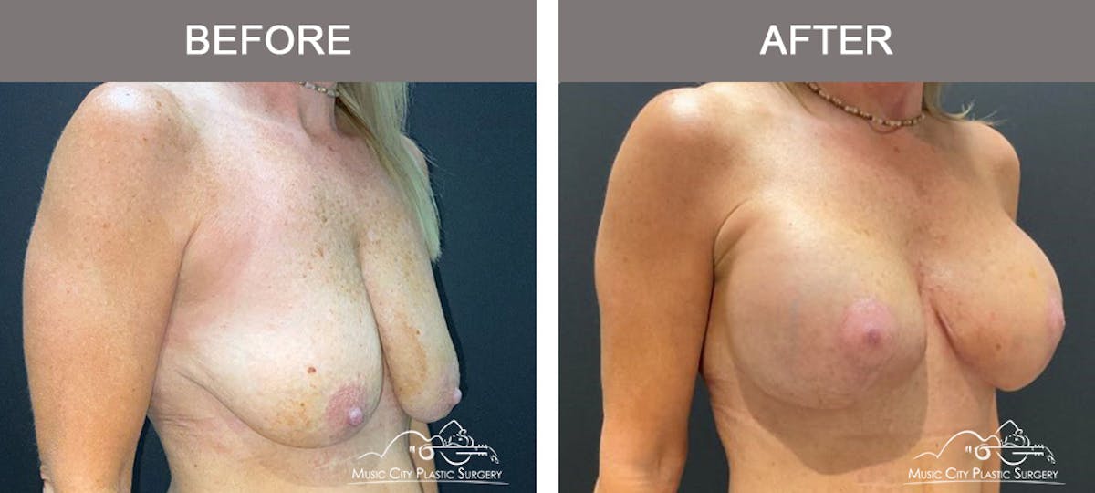 Breast Lift Before & After Gallery - Patient 543148 - Image 2