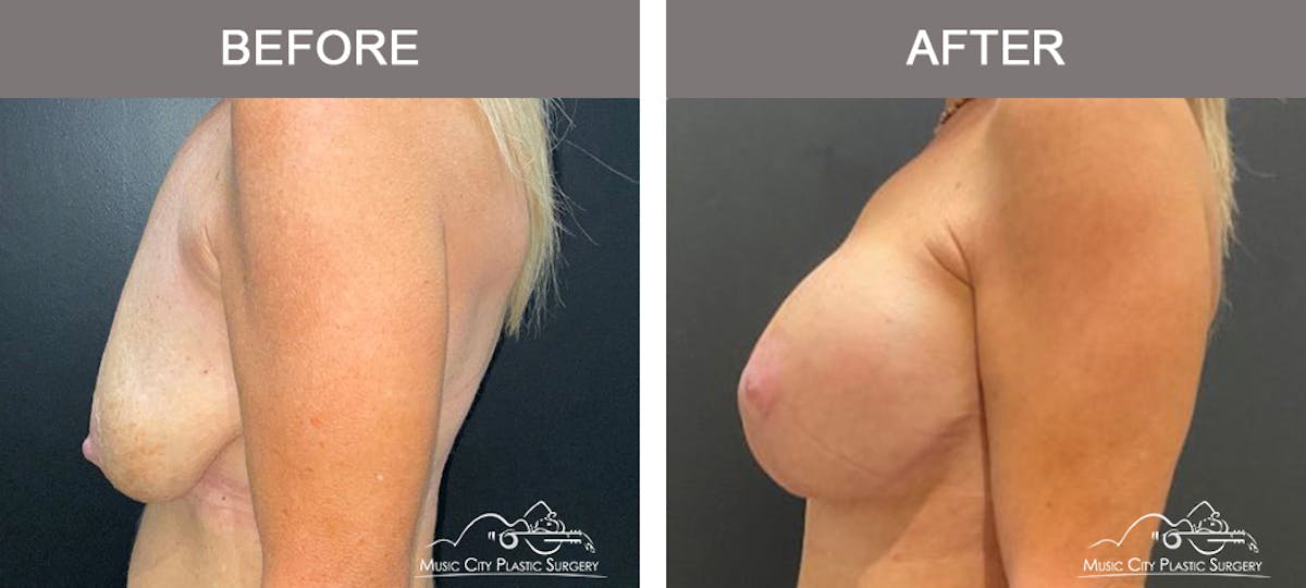 Breast Lift Before & After Gallery - Patient 543148 - Image 5