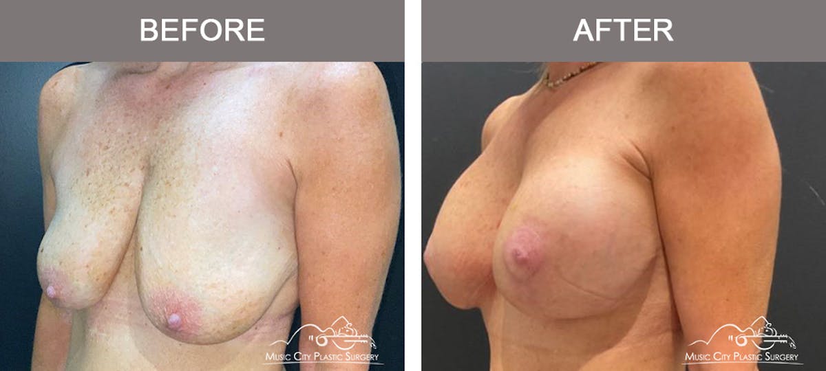 Breast Augmentation Before & After Gallery - Patient 379548 - Image 4