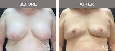 Mastopexy with Capsulectomy Before & After Gallery - Patient 158145 - Image 1