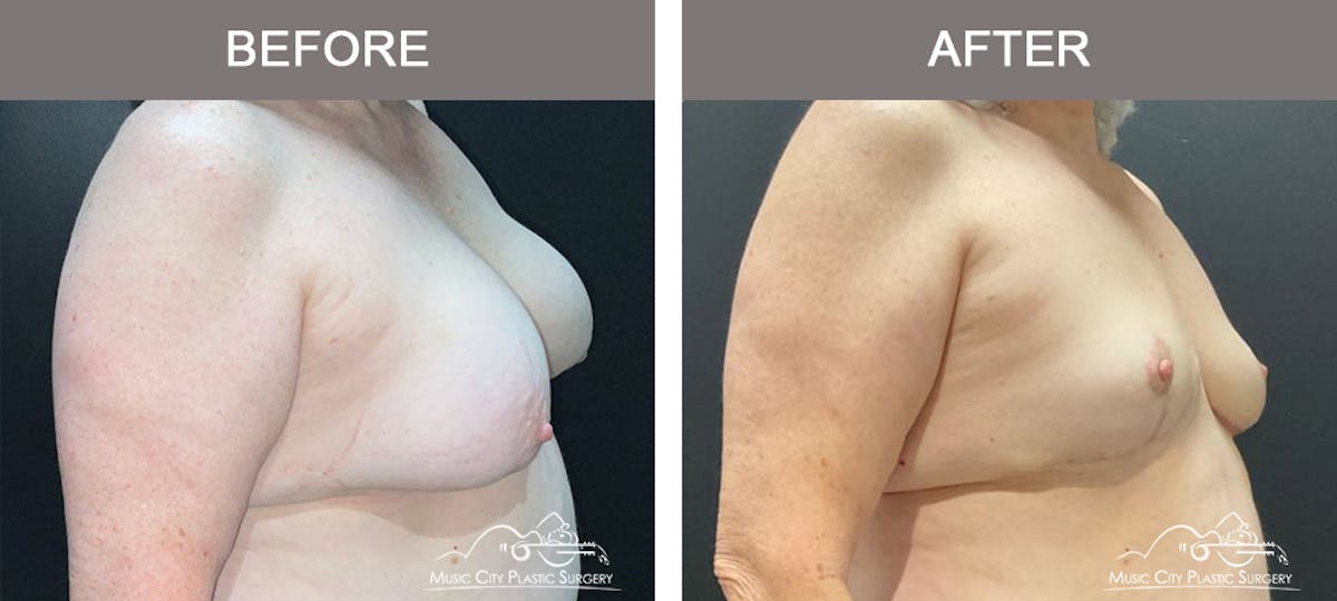 Mastopexy with Capsulectomy Before & After Gallery - Patient 158145 - Image 2