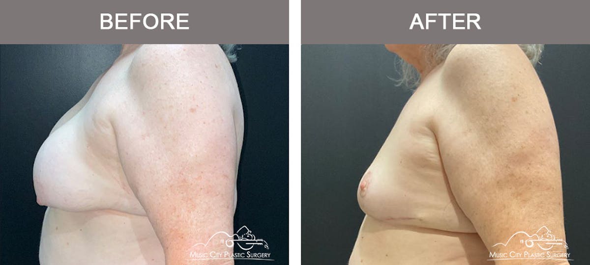 Mastopexy with Capsulectomy Before & After Gallery - Patient 158145 - Image 5