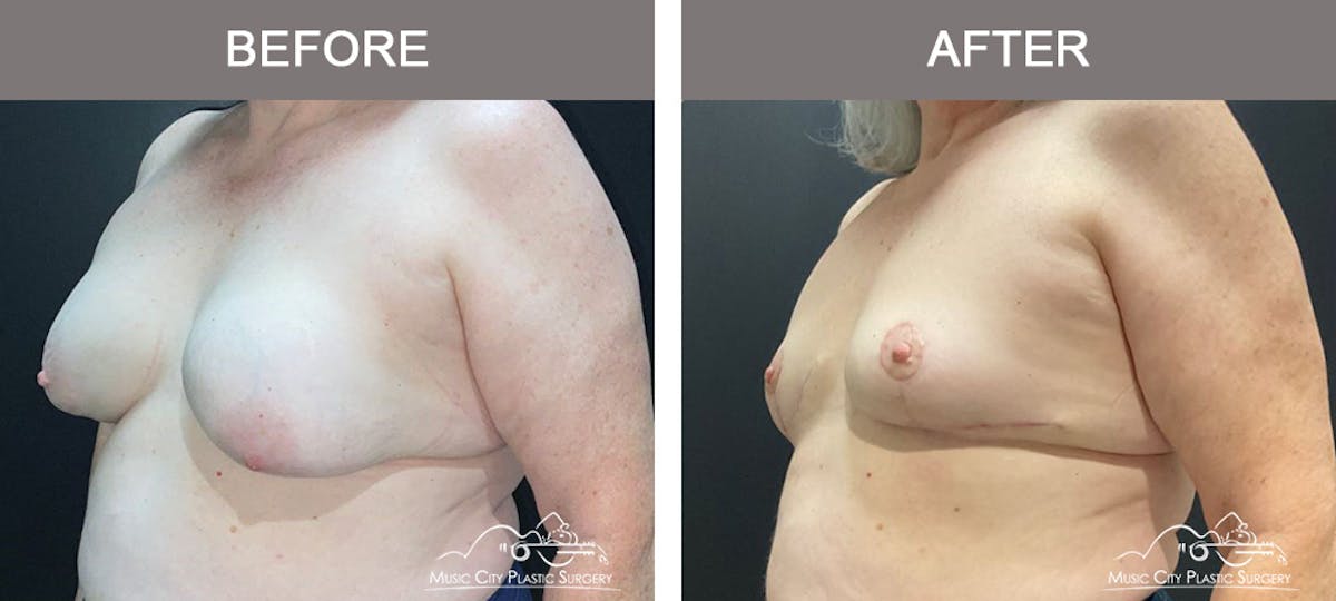 Mastopexy with Capsulectomy Before & After Gallery - Patient 158145 - Image 4