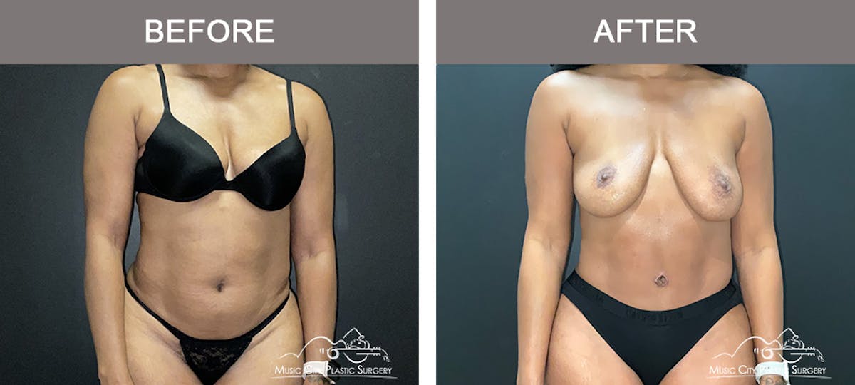 Abdominoplasty Before & After Gallery - Patient 290691 - Image 1