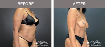 Abdominoplasty Before & After Gallery - Patient 290691 - Image 2