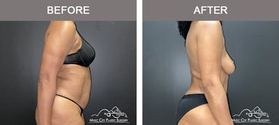 Abdominoplasty Before & After Gallery - Patient 290691 - Image 3