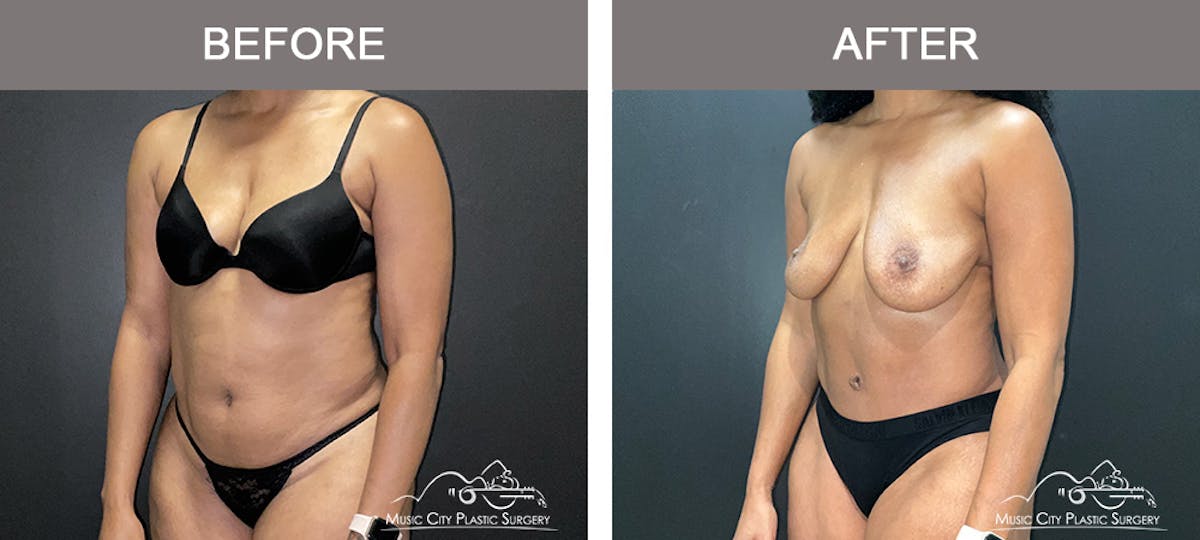 Abdominoplasty Before & After Gallery - Patient 290691 - Image 4