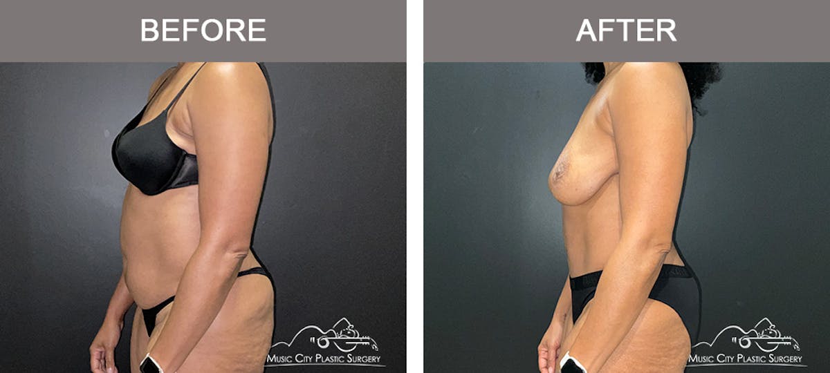 Abdominoplasty Before & After Gallery - Patient 290691 - Image 5