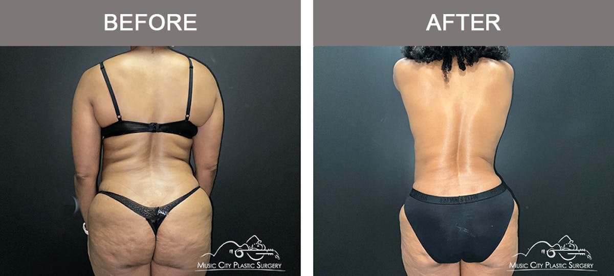 Abdominoplasty Before & After Gallery - Patient 290691 - Image 6