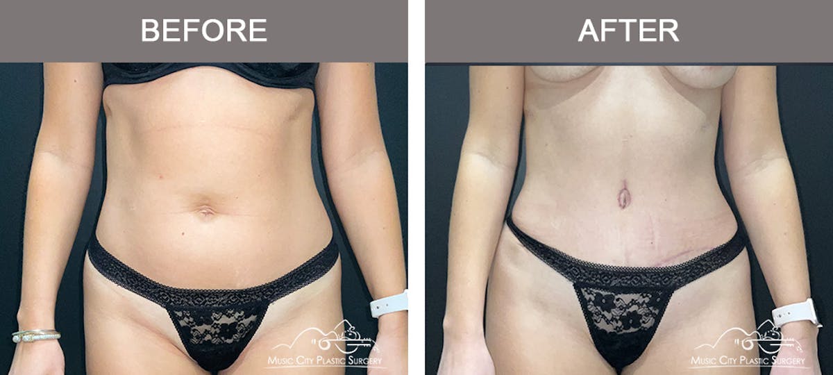 Abdominoplasty Before & After Gallery - Patient 217177 - Image 1