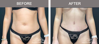 Abdominoplasty Before & After Gallery - Patient 217177 - Image 1