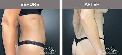 Abdominoplasty Before & After Gallery - Patient 217177 - Image 3