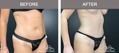 Abdominoplasty Before & After Gallery - Patient 217177 - Image 2