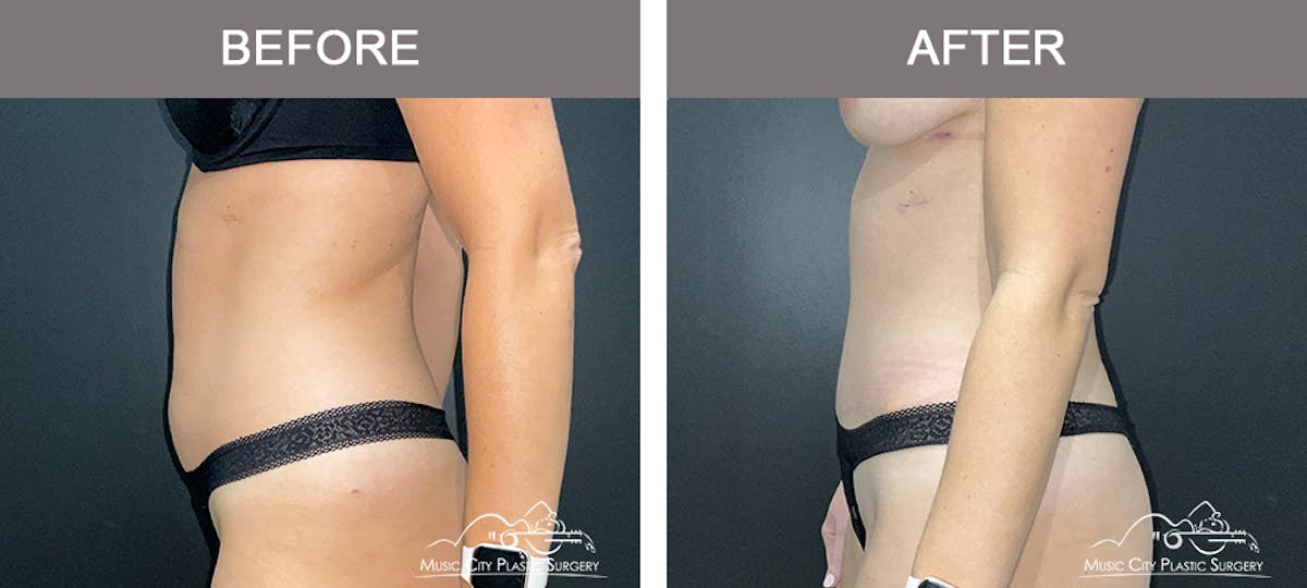Abdominoplasty Before & After Gallery - Patient 217177 - Image 5