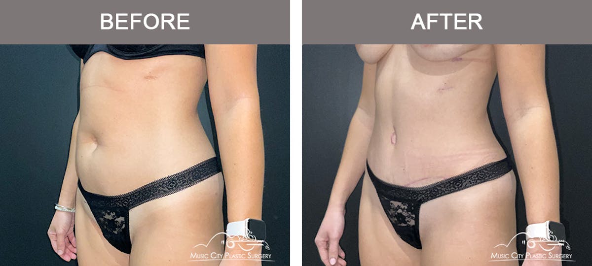 Abdominoplasty Before & After Gallery - Patient 217177 - Image 4