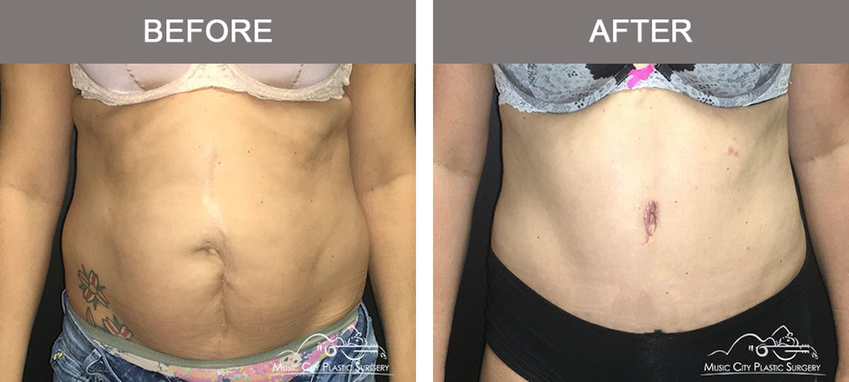 Abdominoplasty Before & After Gallery - Patient 134343 - Image 1